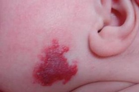 Цвет кожи лица новорожденного thumbnail