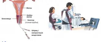 Процесс выполнения гистеросальпингографии