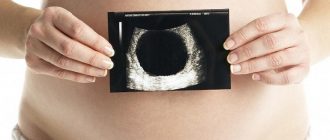 Анэмбриональная беременность