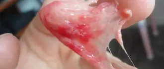 Выходящая ткань при выкидыше