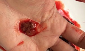 Болит живот кровотечение после выкидыша thumbnail
