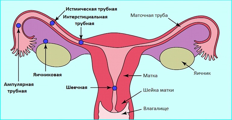 Виды внематочной беременности