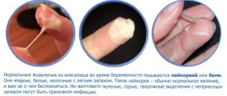 Лейкорея при беременности