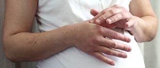 Отечность рук у беременной