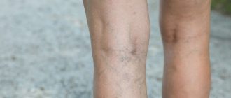 Варикозное расширение вен на ногах у женщины