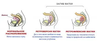 Типы загиба матки