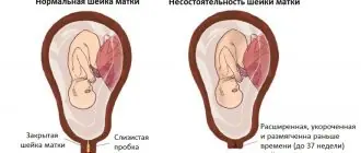 Истмико-цервикальная недостаточность