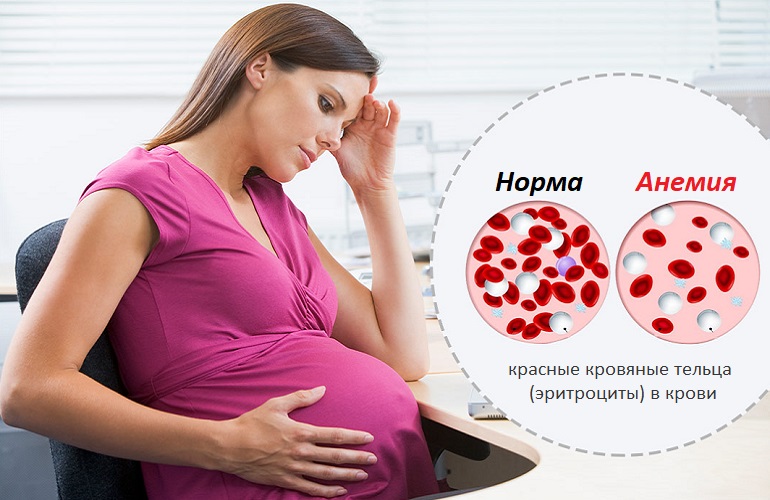 Железодефицитная анемия. Симптомы у женщин, причины, лечение после родов, при беременности, в пожилом возрасте