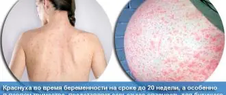 Сыпь при краснухе на спине у беременной женщины