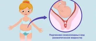 Подтекание околоплодных вод