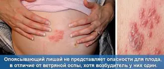 Опоясывающий лишай у беременной